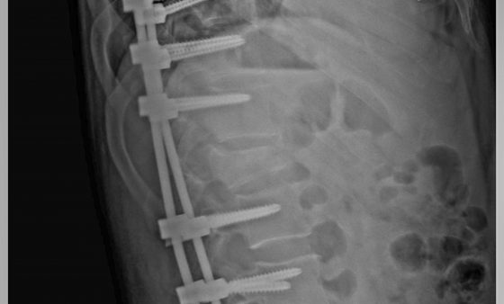 X-ray of Daniel Bosh's back post surgery.